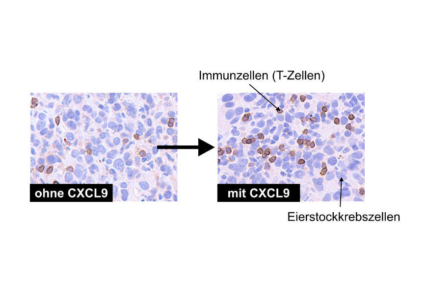 Der Botenstoff CXCL9, ein sog. Chemokin, verbessert die Einwanderung von Immunzellen in Eierstockkrebstumore: ohne CXCL9 (linkes Bild) finden sich nur vereinzelt T-Zellen im Tumor, während ihre Zahl deutlich zunimmt, wenn die Tumorzellen CXCL9 produzieren (rechtes Bild).