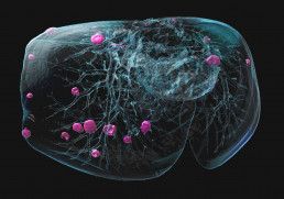 Grafik eines Tumors