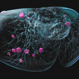 Grafik eines Tumors