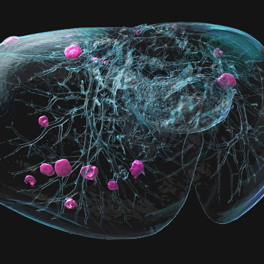 Grafik eines Tumors
