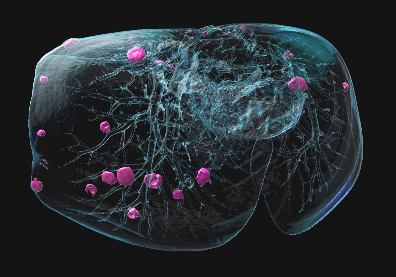 Grafik eines Tumors